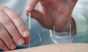 acupuncture for stroke care